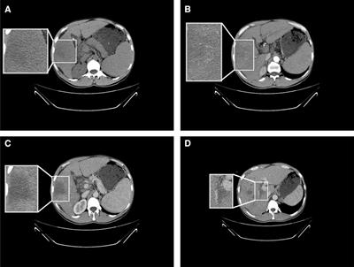 Occurrence–regression–recurrence of hepatocellular carcinoma without any intervention: A case report